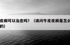 牛皮癣可以治愈吗？（请问牛皮皮癣是怎么引起的）